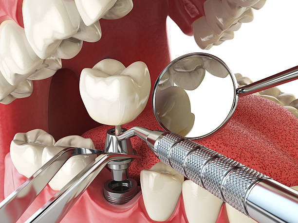 Best Emergency Denture Repair in St Charles, MO